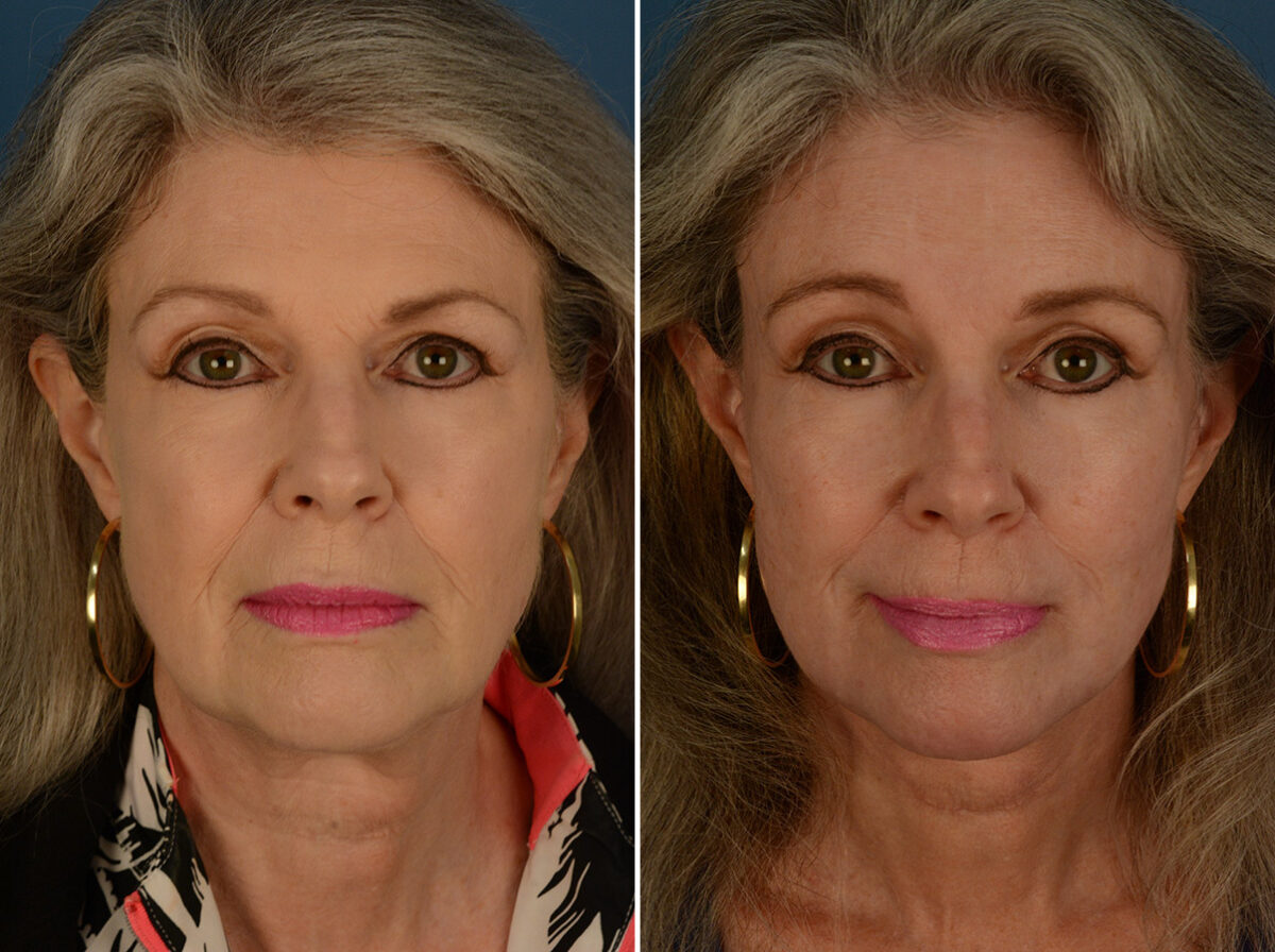 Endoscopic Facelift Before and After Photos in Naples, FL, Patient 30482