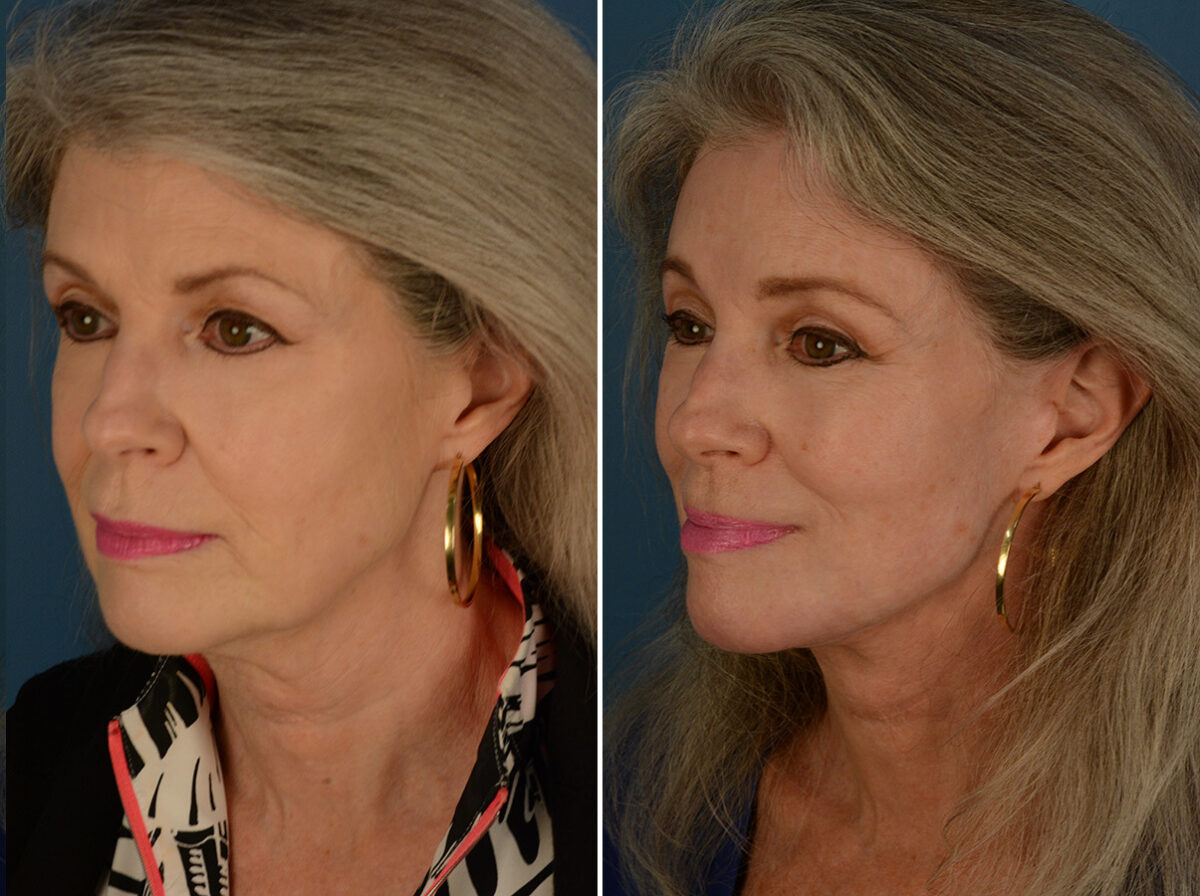 Endoscopic Facelift Before and After Photos in Naples, FL, Patient 30482