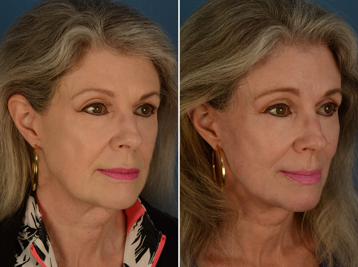 Endoscopic Facelift Before and After Photos in Naples, FL, Patient 30482