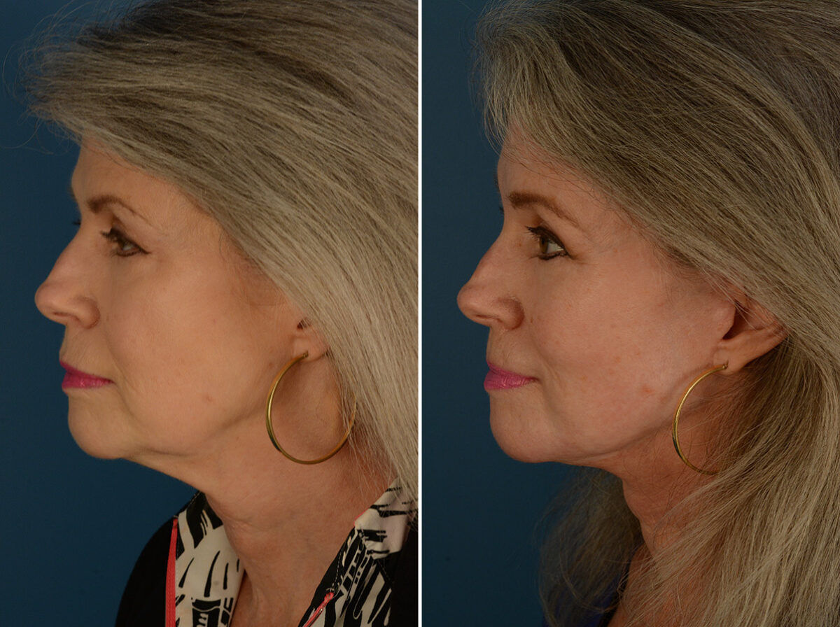Endoscopic Facelift Before and After Photos in Naples, FL, Patient 30482