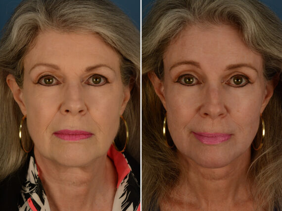 Endoscopic Facelift Before and After Photos in Naples, FL, Patient 30482