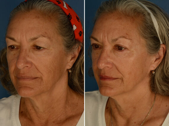 Blepharoplasty Before and After Photos in Naples, FL, Patient 30523