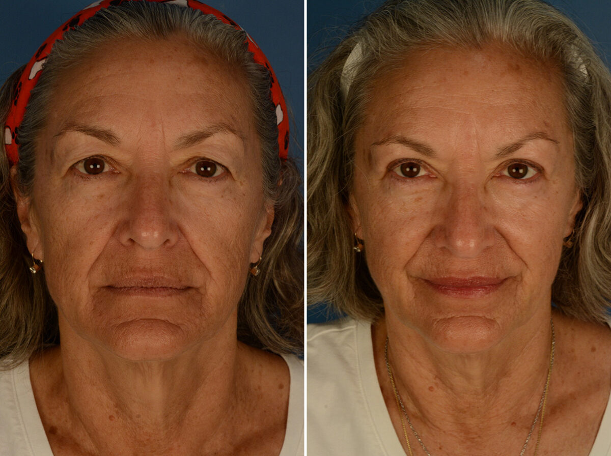 Blepharoplasty Before and After Photos in Naples, FL, Patient 30523