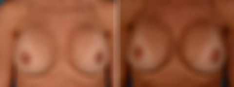 Breast Implant Exchange Before and After Photos in Naples, FL, Patient 30578