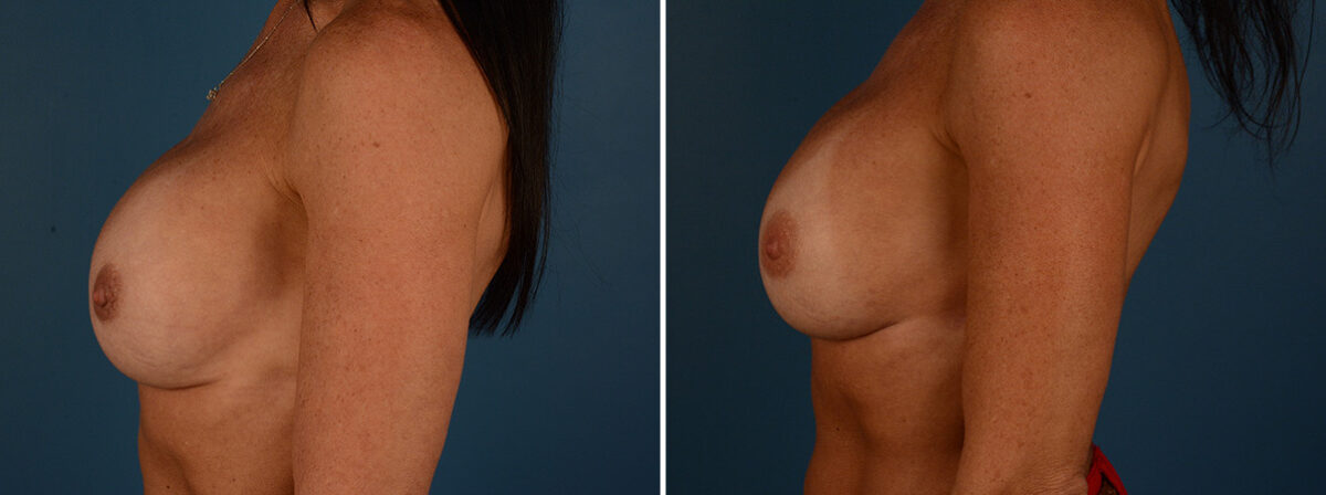 Breast Implant Exchange Before and After Photos in Naples, FL, Patient 30578