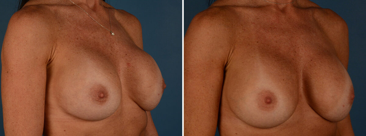 Breast Implant Exchange Before and After Photos in Naples, FL, Patient 30578