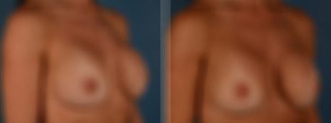 Breast Implant Exchange Before and After Photos in Naples, FL, Patient 30578