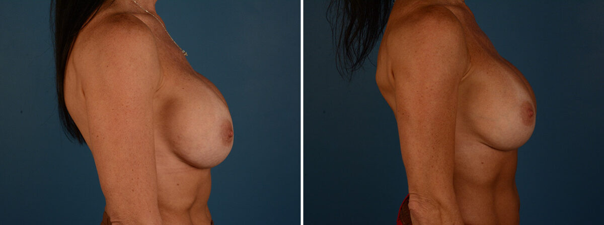 Breast Implant Exchange Before and After Photos in Naples, FL, Patient 30578