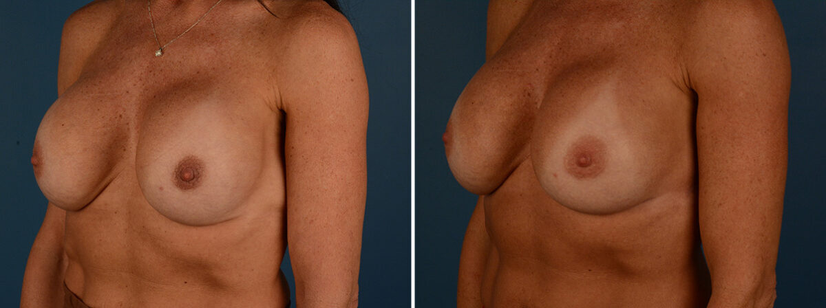 Breast Implant Exchange Before and After Photos in Naples, FL, Patient 30578