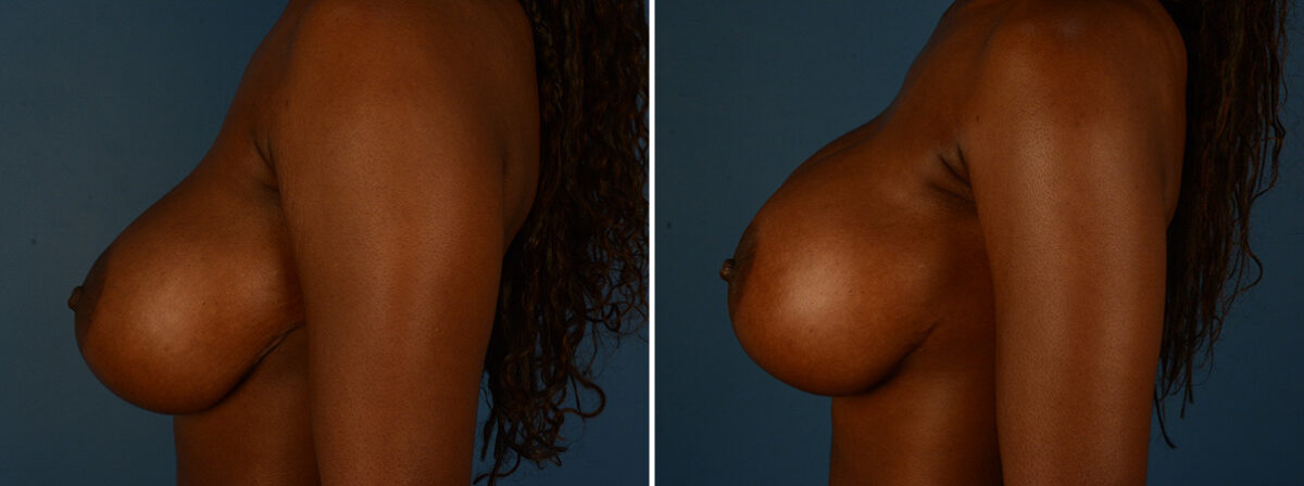 Breast Implant Exchange Before and After Photos in Naples, FL, Patient 30601