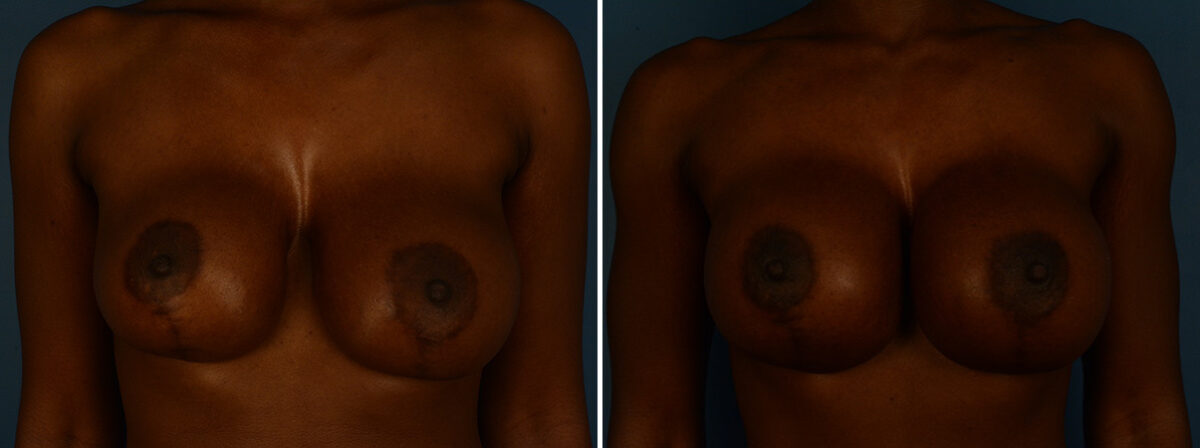 Breast Implant Exchange Before and After Photos in Naples, FL, Patient 30601