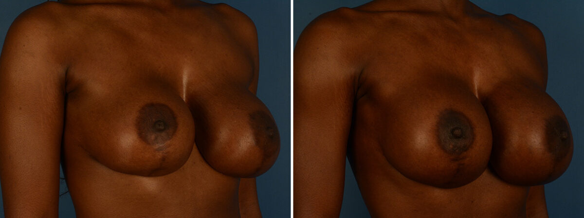 Breast Implant Exchange Before and After Photos in Naples, FL, Patient 30601