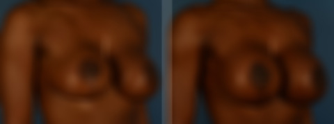 Breast Implant Exchange Before and After Photos in Naples, FL, Patient 30601