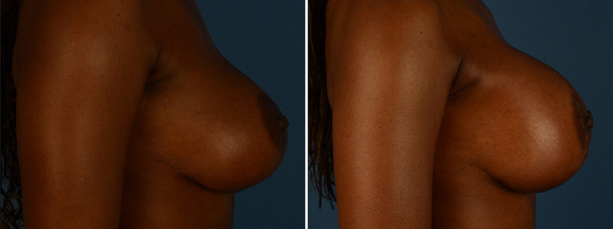 Breast Implant Exchange Before and After Photos in Naples, FL, Patient 30601
