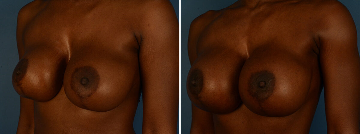 Breast Implant Exchange Before and After Photos in Naples, FL, Patient 30601