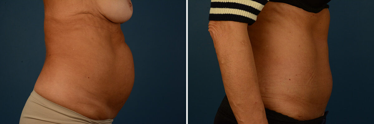 Abdominoplasty Before and After Photos in Naples, FL, Patient 30638