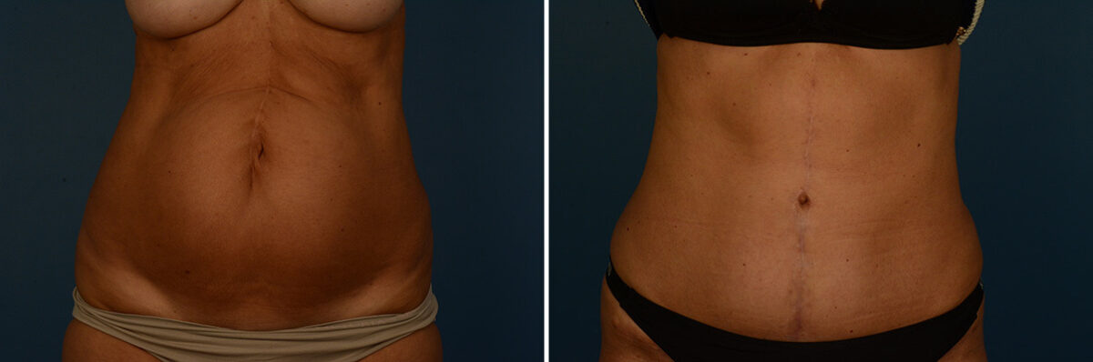 Abdominoplasty Before and After Photos in Naples, FL, Patient 30638