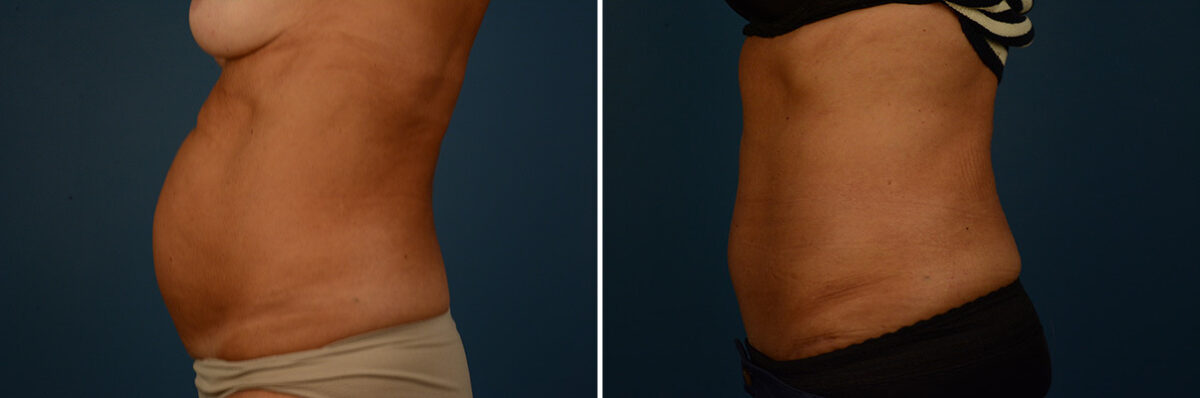 Abdominoplasty Before and After Photos in Naples, FL, Patient 30638