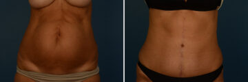 Abdominoplasty Before and After Photos in Naples, FL, Patient 30638