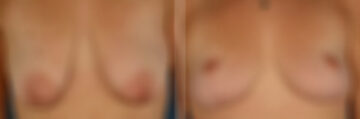 Breast Lift Before and After Photos in Naples, FL, Patient 30649