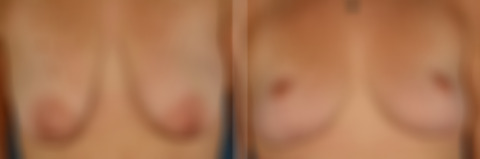 Breast Lift Before and After Photos in Naples, FL, Patient 30649
