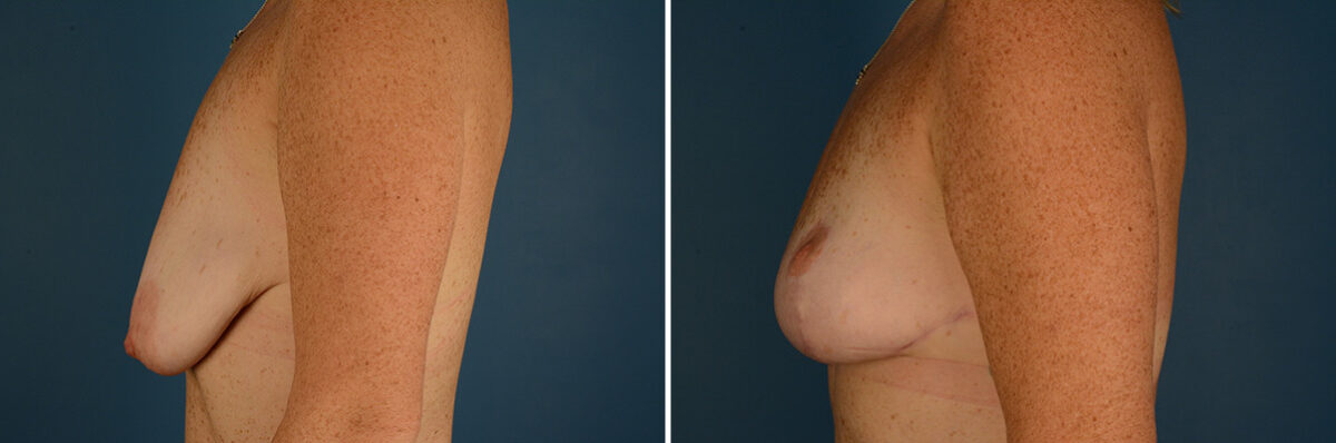 Breast Lift Before and After Photos in Naples, FL, Patient 30649