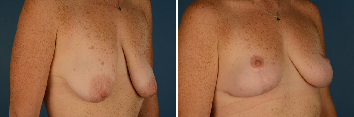 Breast Lift Before and After Photos in Naples, FL, Patient 30649
