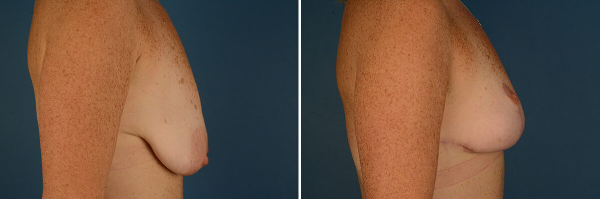 Breast Lift Before and After Photos in Naples, FL, Patient 30649