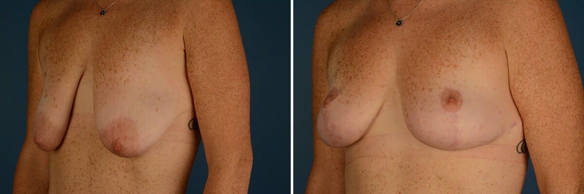 Breast Lift Before and After Photos in Naples, FL, Patient 30649