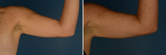 VASER® Liposuction with Renuvion Before and After Photos in Naples, FL, Patient 30672