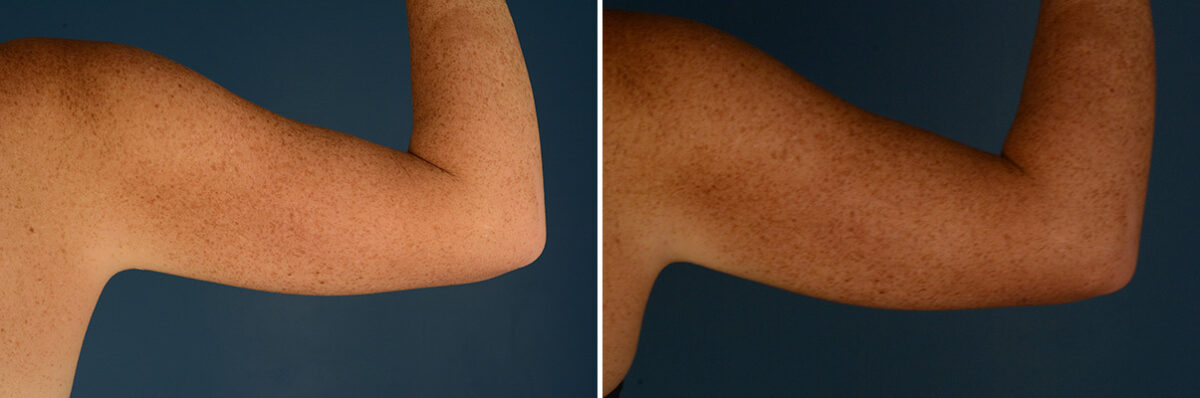 VASER® Liposuction with Renuvion Before and After Photos in Naples, FL, Patient 30672
