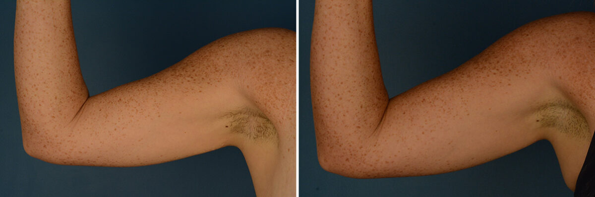 VASER® Liposuction with Renuvion Before and After Photos in Naples, FL, Patient 30672