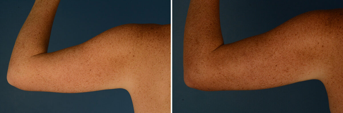 VASER® Liposuction with Renuvion Before and After Photos in Naples, FL, Patient 30672