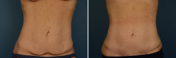 VASER® Liposuction with Renuvion Before and After Photos in Naples, FL, Patient 30672