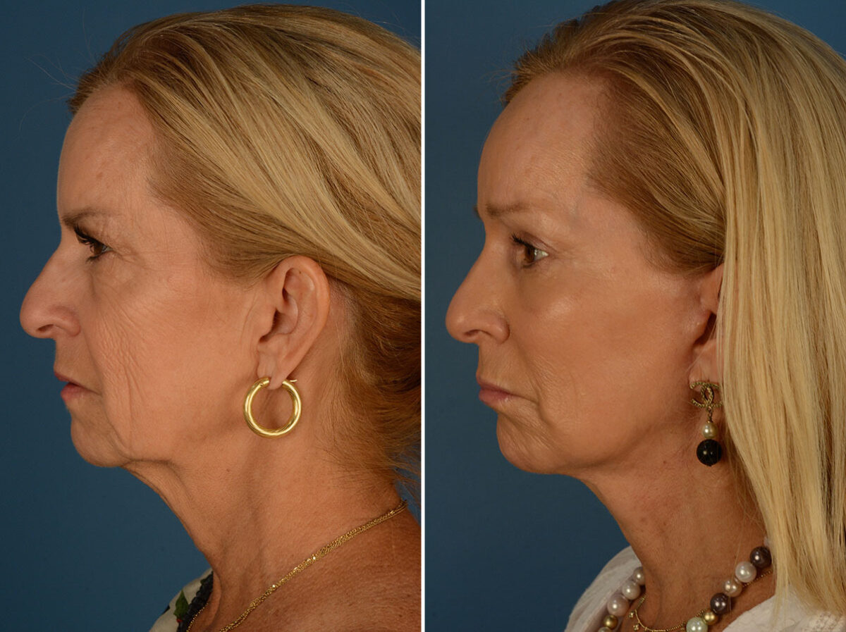 Endoscopic Facelift Before and After Photos in Naples, FL, Patient 25477