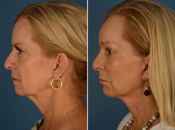 Endoscopic Facelift Before and After Photos in Naples, FL, Patient 25477