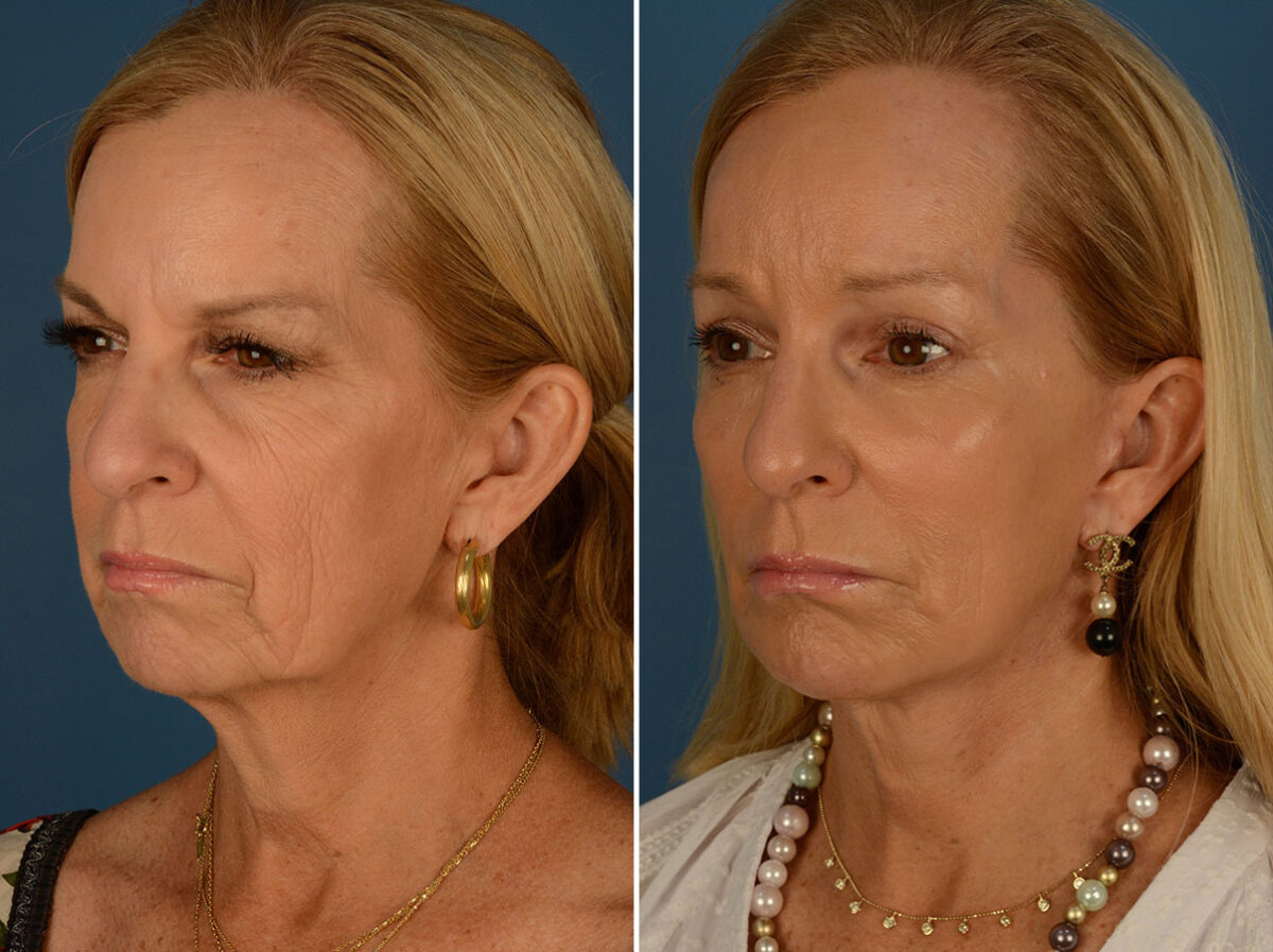 Endoscopic Facelift Before and After Photos in Naples, FL, Patient 25477