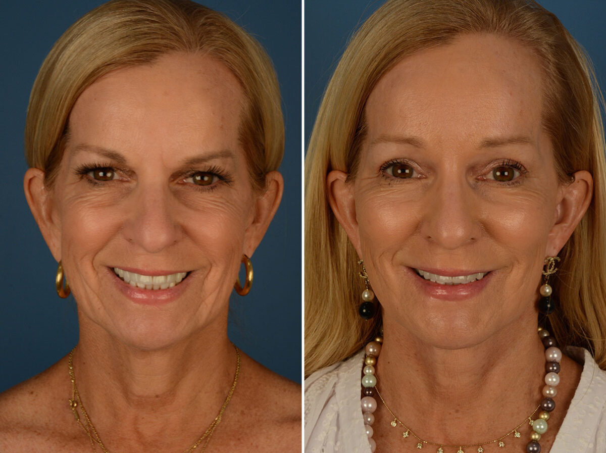 Endoscopic Facelift Before and After Photos in Naples, FL, Patient 25477