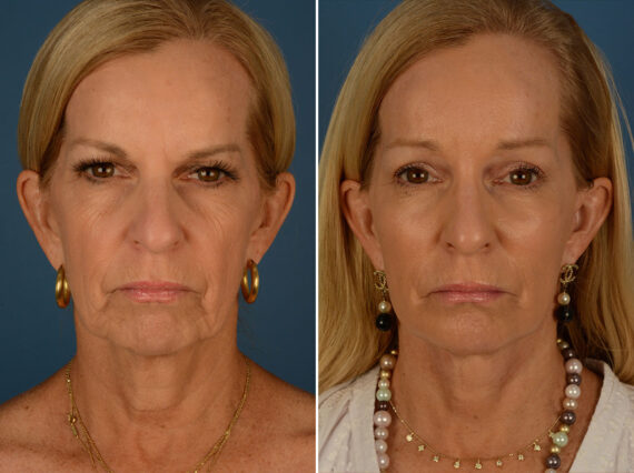 Endoscopic Facelift Before and After Photos in Naples, FL, Patient 25477