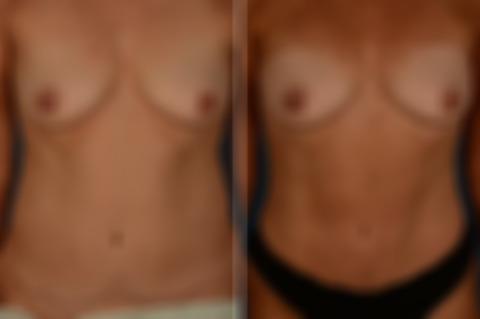 VASER® Liposuction with Renuvion Before and After Photos in Naples, FL, Patient 30721