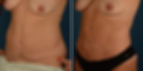 VASER® Liposuction with Renuvion Before and After Photos in Naples, FL, Patient 30721