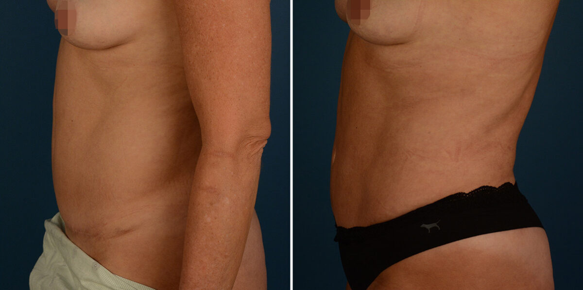 VASER® Liposuction with Renuvion Before and After Photos in Naples, FL, Patient 30721