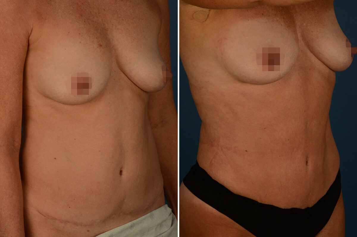VASER® Liposuction with Renuvion Before and After Photos in Naples, FL, Patient 30721