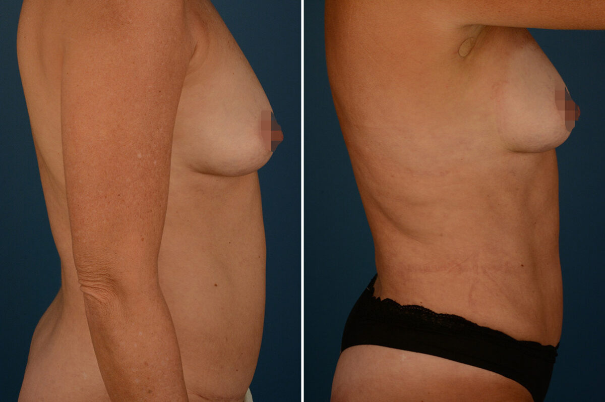 VASER® Liposuction with Renuvion Before and After Photos in Naples, FL, Patient 30721