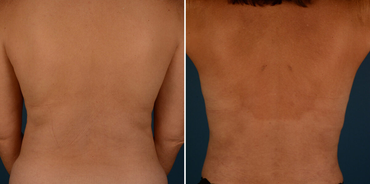 VASER® Liposuction with Renuvion Before and After Photos in Naples, FL, Patient 30721