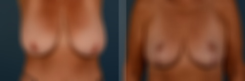 Breast Lift Before and After Photos in Naples, FL, Patient 30796
