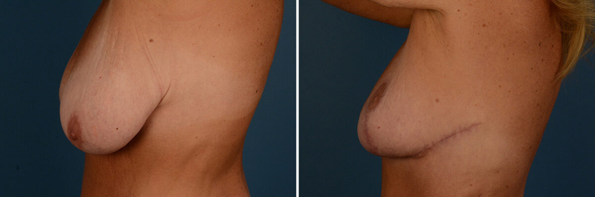 Breast Lift Before and After Photos in Naples, FL, Patient 30796
