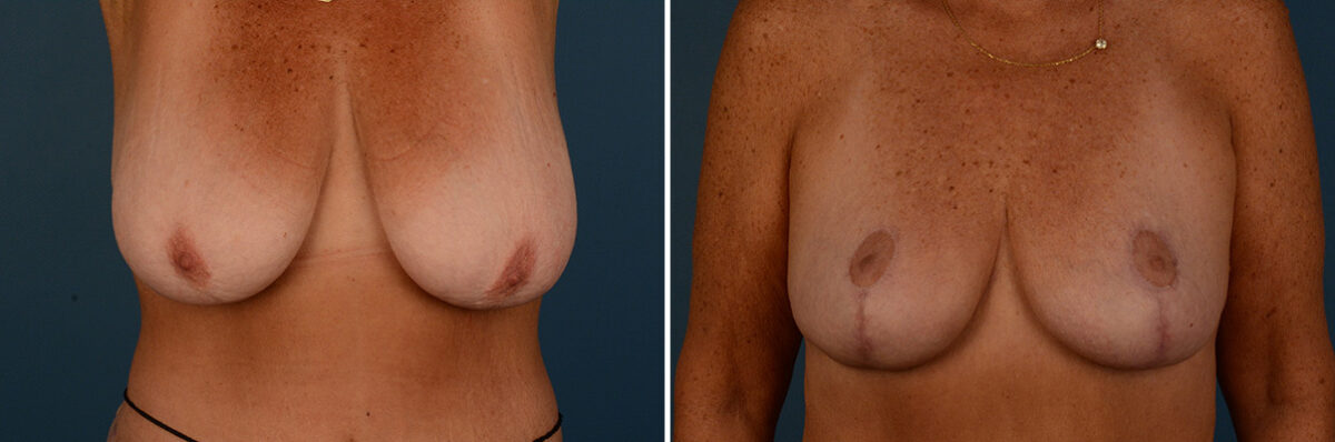 Breast Lift Before and After Photos in Naples, FL, Patient 30796