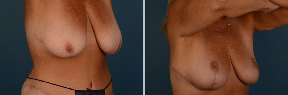 Breast Lift Before and After Photos in Naples, FL, Patient 30796