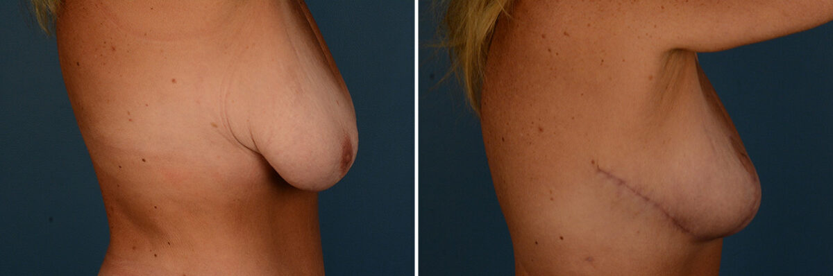 Breast Lift Before and After Photos in Naples, FL, Patient 30796